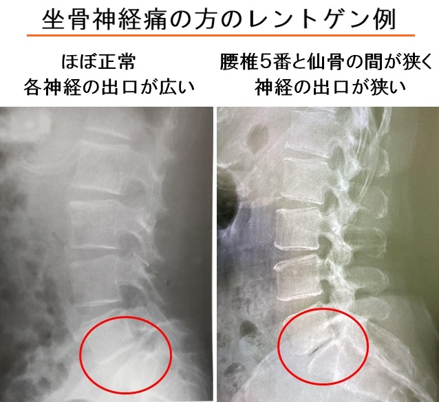 坐骨神経痛のレントゲン例