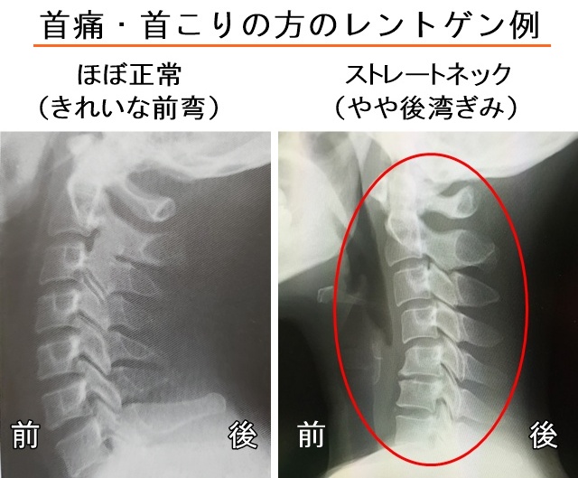 首の痛みの方のレントゲン例