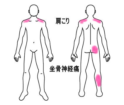 症例報告ー坐骨神経痛