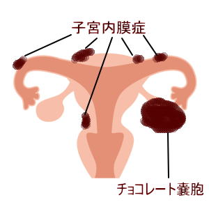 子宮内膜症―元氣カイロ院