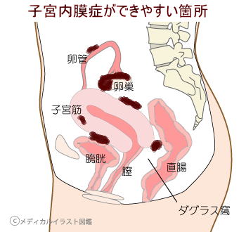 内膜症ができやすい箇所